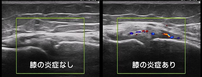 膝関節炎・滑膜炎