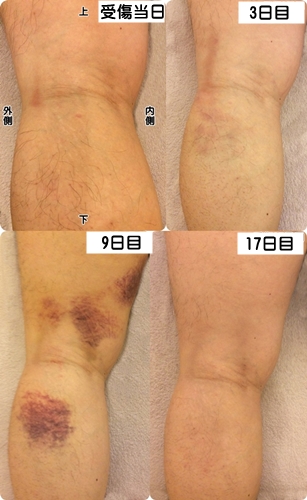 ふともも・太腿の肉離れ・中京区右京区下京区
