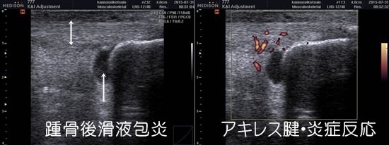 京都市｜マラソン｜ランニング｜急性アキレス腱炎