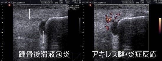 京都市｜マラソン｜ランニング｜急性アキレス腱炎