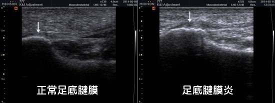 京都市｜マラソン｜ランニング｜足底腱膜炎