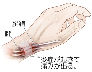 腱鞘炎・ばね指治療京都市下京区整骨院接骨院