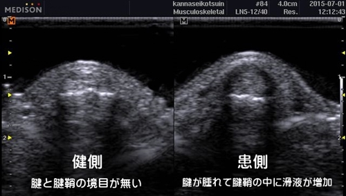 腱鞘炎・ばね指治療京都市整形外科