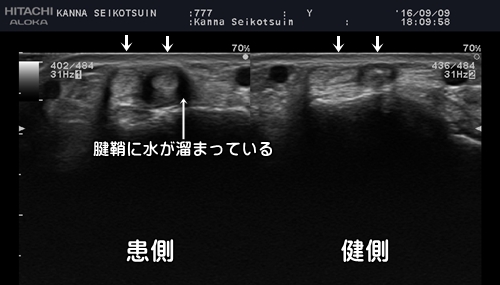 腱鞘炎・ばね指治療京都市整形外科